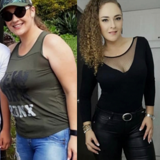 Mujer con Antes y después de perder peso con tratamiento Diamante
